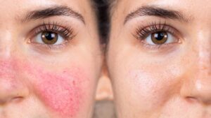 Rosacea-Treatments-H