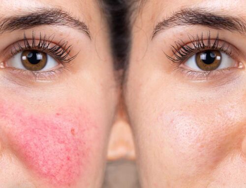 Alternatives to Laser Treatment For Rosacea