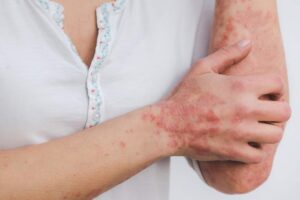 Psoriasis on arms